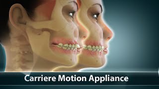 Carriere Motion Orthodontic Treatment  Curveia Dental Animation  Patient Education Video [upl. by Ostap30]