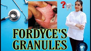 Fordyces granules  गाल के अंदर लाल और पीले स्पॉट्स का इलाज  causes of fordyces spots [upl. by Naillig]