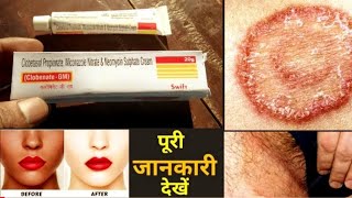 Clobenate Gm cream Uses in HindiBenefits amp Side Effect And How to use in Hindi [upl. by Bronny103]