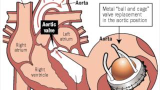 Pyrolytic Carbon Heart Valves  Graphene MCV [upl. by Callean]