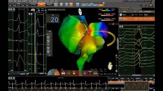 ablation d ESV au niveau du left ventricular summit [upl. by Ahsiuqal]