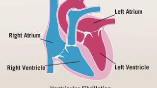 Ventricular Fibrillation [upl. by Sievert]