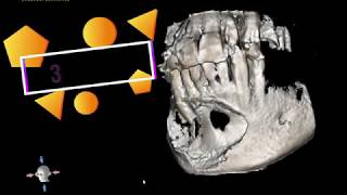 Mandibular Cyst [upl. by Kennett]