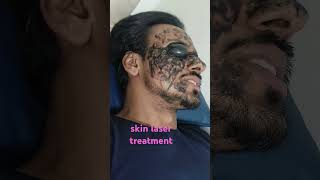 skin laser treatment mumbai besthairtransplant hairfall [upl. by Jaenicke]