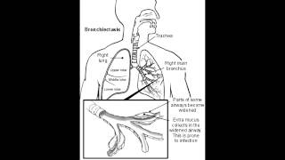 Bronchiectasis  USMLE Step 1  First Aid [upl. by Lezti]