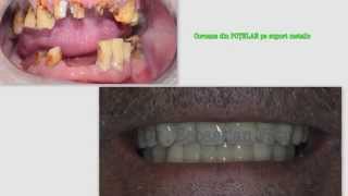 Coroane dentare  portelan  zirconiu  ceramica [upl. by Ainivad]