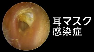 Serious Ear Mask Infection Clean Out [upl. by Queston756]