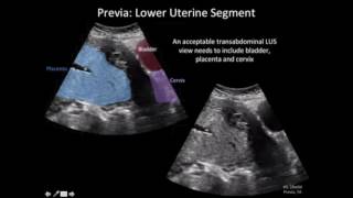 Ultrasound Diagnosis of Placenta Accreta A Tutorial for Imagers [upl. by Friedrick]