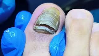 Painful Black Toenail Fungus Removal 【Yinuo Pedicure】 [upl. by Humberto]