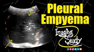 Pleural Empyema  Ultrasound  Case 156 [upl. by Noffihc]