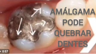 AMÁLGAMAS PODEM QUEBRAR DENTESdentistarj [upl. by Rutherfurd355]