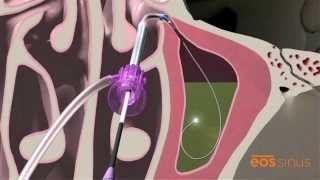 Balloon Sinuplasty Treatment for Chronic Sinusitis  NonInvasive Sinus Procedure [upl. by Venuti]