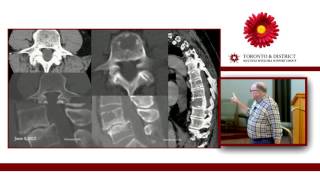 Kyphoplasty Vertebral Augmentation for Myeloma The Cement Facts  Is It Worth It [upl. by Moreno241]