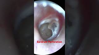 Perforated Eardrum [upl. by Newbold]