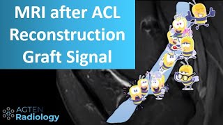 Knee MRI after ACL Reconstruction Surgery  Part 1  Signal intensity [upl. by Ueih673]