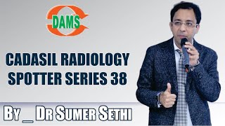 CADASIL Radiology Spotter Series 38 By Dr Sumer Sethi [upl. by Algie]