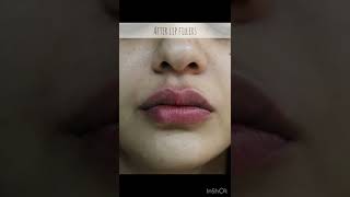 Lip Filler Before and After Compilation  LIP FILLER drjyotiguptadermatologist7266 Lip Injections [upl. by Airdnna]