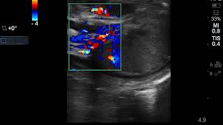 Case 1  Epididymo orchitis clip 2 [upl. by Dielle485]