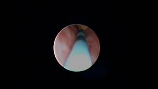 URETEROSCOPIA CON LITOTRIPSIA LASER HOLMIUM [upl. by Ggerg949]