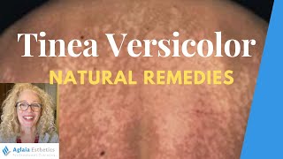 NATURAL HOME REMEDIES FOR TINEA VERSICOLOR [upl. by Kcered]