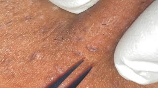 Ingrown Hair Removal Ep29 [upl. by Ydnab]