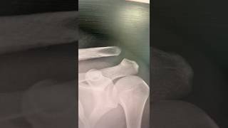 injury scootering mounthawkeskatepark2035 skatepark indoor subscribe [upl. by Eixid]