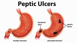 Peptic Ulcer Disease 2020 [upl. by Pauiie]