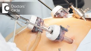 Gynaecologic Laparoscopy Uses amp Benefits  Dr Nupur Sood [upl. by Alius186]