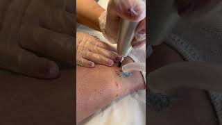 Laser Tattoo Removal in action laser lasertattooremoval [upl. by Alohcin]