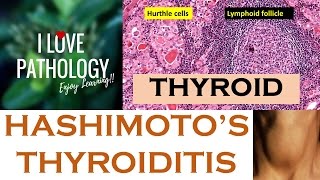 HASHIMOTOS THYROIDITIS Etiopathogenesis Morphology amp Complications [upl. by Yonit42]