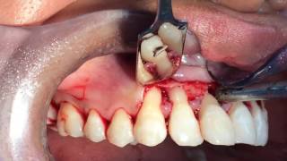 Cirugía periodontal regenerativa con Emdogain y preservación de papila [upl. by Eanel]