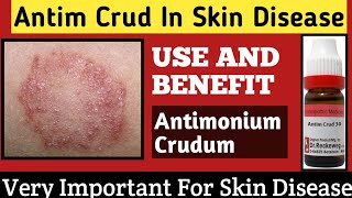 Antim Crud In Skin Disease  Antimonium Crudum  Skin Disease Treatment  Antimonium Crudum  200 [upl. by Lamonica]