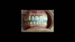 gingivectomyoralsurgeryperiodontalsurgery [upl. by Nidroj]