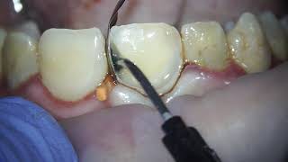 replacing a filling on the front central incisor  filling on a front tooth dentist teeth cavity [upl. by Erland]