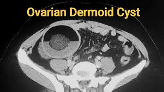 Ovarian Dermoid Cyst [upl. by Otero597]