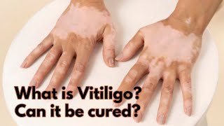 Understanding Vitiligo A Chronic autoimmune disorder 📚trendingvideo humanhealth facts genetics [upl. by Jean]