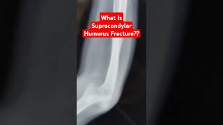 What Is Supracondylar Humerus Fracture Dr Sai Chandra MBBS DNB Ortho FIAS South Korea FIJR Germany [upl. by Winston156]