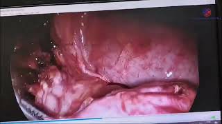 laproscopic removal of Tubo ovarian mass [upl. by Alonso]