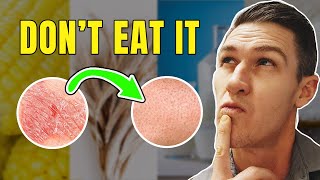 Top 5 Foods to Remove if you Have Psoriasis [upl. by Rolyt]