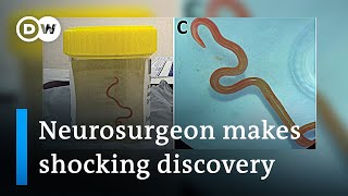 Neurosurgeon removes live worm from womans brain in worldfirst discovery  DW News [upl. by Reube]