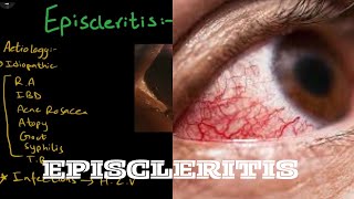 Episcleritis  Aetiology  pathogenesis  clinical features  treatment [upl. by Drewett]