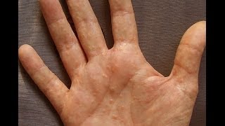 Dermatitis or Dyshidrosis How I Prevent Getting Painful And Unsightly Summer Hands [upl. by Naimad]