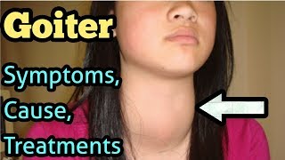 Goiter Symptoms Causes Treatment [upl. by Prouty212]