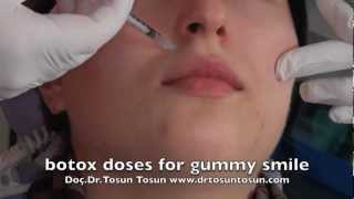 botox doses for gummy smile [upl. by Thurmann]