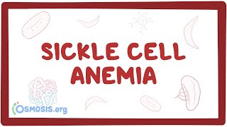 Sickle cell anemia  causes symptoms diagnosis treatment amp pathology [upl. by Therese902]