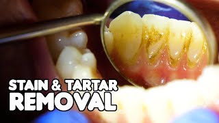 Dental Cleaning EXPLAINED  Stain amp Tartar Removal [upl. by Sregor]