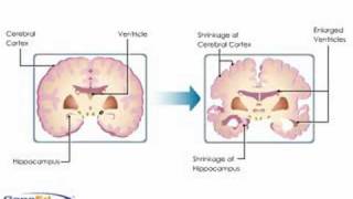 Alzheimers Disease Neuropathology [upl. by Halihs]