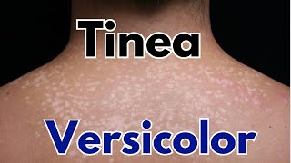 Tinea versicolor symptoms treatment  how to get rid of tinea versicolor [upl. by Niggem]