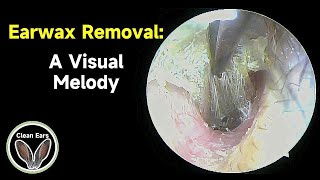 Cerumen Removal A Visual Melody [upl. by Aihsat740]