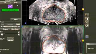 How to perform a prostate fusion guided biopsy UroNav v 11 [upl. by Zehc]